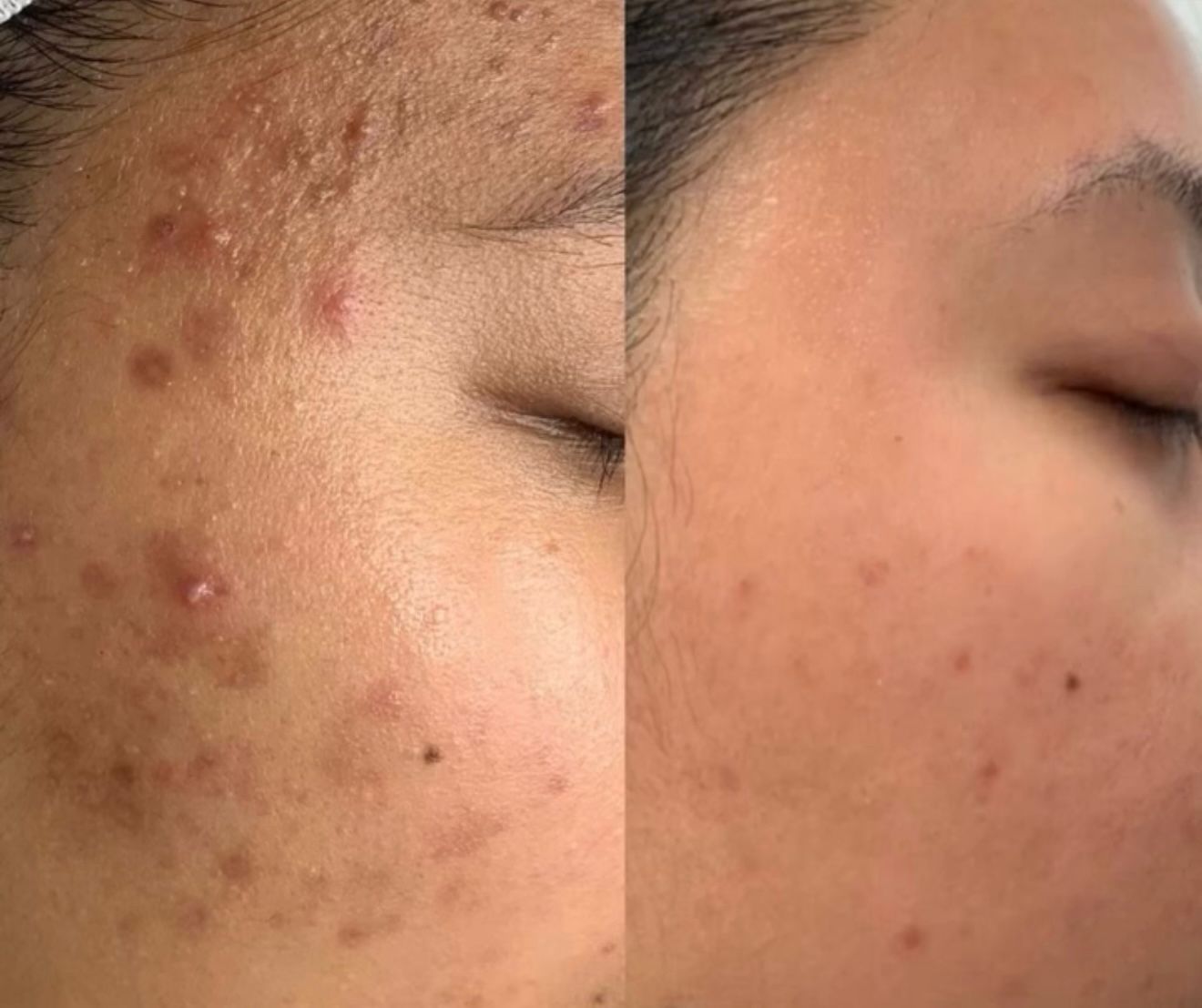 CLEAR ADVANCE™ – Elimina el Acne Hormonal